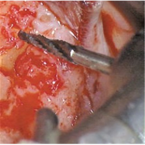 TH162SXL314014X5 - Tungsten Carbide Bur KOMET #H162SXL-014 Bone Cutter